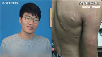 酸性體質容易被蚊子咬？真相嚇壞網友