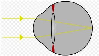 一秒變清晰！超神「近視急救術」曝光