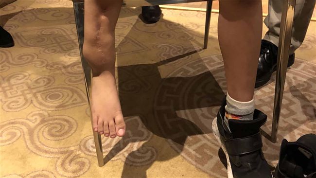 男孩罹罕見骨病沒法治　台醫師伸援手
