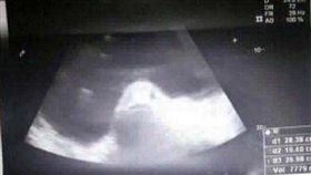 菲律賓,超音波（圖／翻攝自推特）