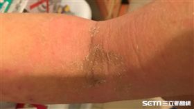 中重度異位性皮膚炎患者手肘彎曲側脫皮。（圖非新聞當事人／公關照）