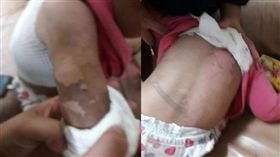 女童,洗澡,燙傷,彰化／爆料公社