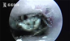 蟑螂鑽進耳朵（圖／翻攝看看新聞）