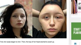 英國,染髮劑,女學生,過敏
https://www.thelocal.fr/20181128/young-french-woman-disfigured-by-hair-dye