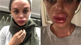 英國女子嘴唇注射肉毒桿菌後，腫脹如香腸嘴。（圖／翻攝自《The Sun》）