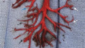 男子狂咳嗽，竟咳出「支氣管樹」凝血塊。（圖／翻攝自新英格蘭醫學期刊）