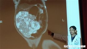 小兒外科主治醫師林介文表示，早期畸胎瘤多無明顯臨床症狀，大多是體檢時偶然發現（圖／三總提供）