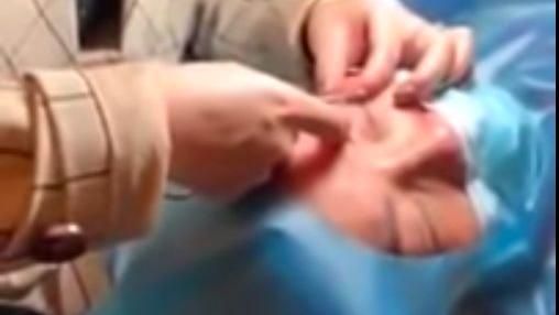 砸13萬割雙眼皮　醫生竟把眼皮縫在眼球上