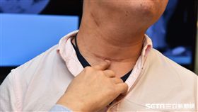 37歲病人劉先生因發現右甲狀腺有腫塊，遂做右甲狀腺和峽部切除及右中央區淋巴廓清術。（圖／雙和醫院提供）