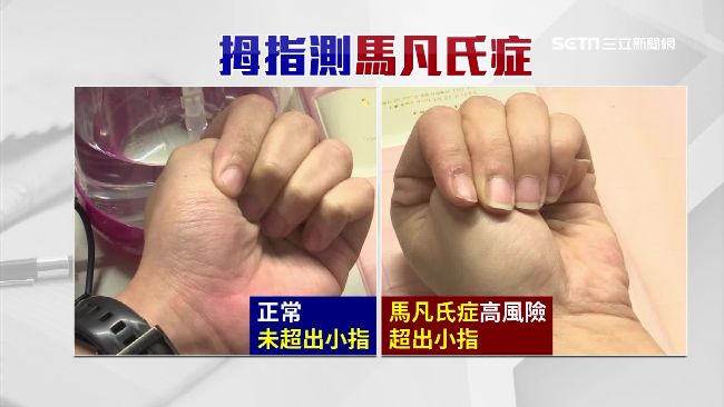手指長這樣　恐是主動脈剝離高危險群
