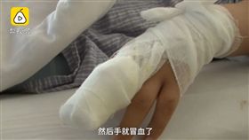 黑龍江,手指,民俗療法,花椒粉,截肢（圖／翻攝自梨視頻）
