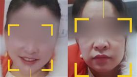 女做微整形，13萬殺價到1.7萬，結果變大媽臉超崩潰。（圖／翻攝搜狐網）