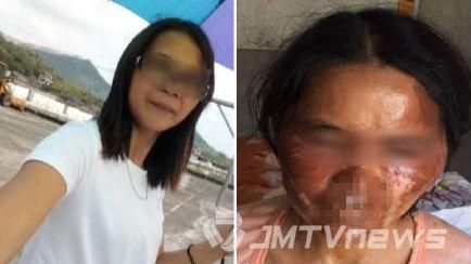 壓力鍋煮粥突爆炸！女子慘遭毀容