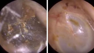 耳屎結團如蜜番薯　挖出衣服標籤超噁