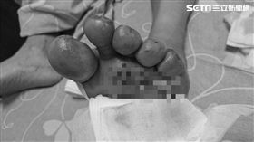 陸客,導遊,粉碎性骨折,嘉義