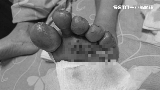 陸客發酒瘋打斷導遊腳骨　傷勢照曝光