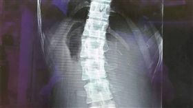 妙齡女背痛難耐  原是脊椎側彎惡化苗栗縣一名22歲戴姓女子經常腰痠背痛，就醫檢查發現，因長期忽視少年時期就發生的脊椎側彎，已惡化並彎曲到25度；醫師提醒，脊椎側彎嚴重恐影響心肺功能，把握黃金治療期加以矯正，避免持續惡化。（苗栗大千醫院提供）中央社記者管瑞平傳真  107年12月14日