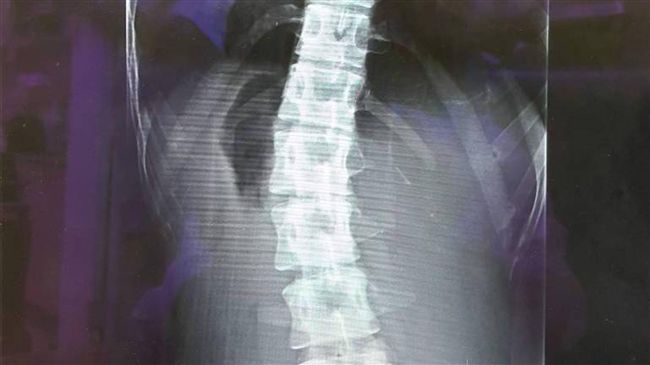 妙齡女脊椎側彎惡化　醫：恐影響心肺