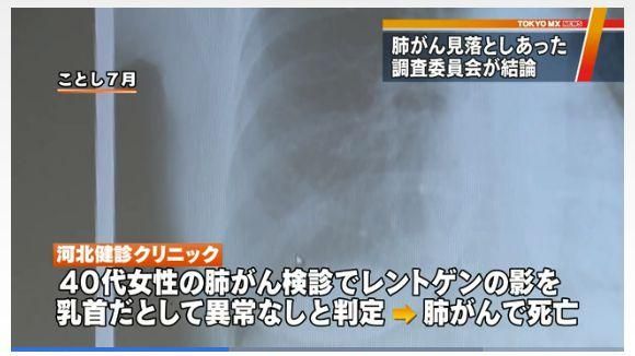 醫把陰影當乳頭　她被誤診3次罹癌死