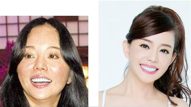 狄鶯代言醫美補錢坑？診所曝續約關鍵