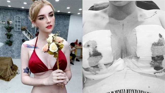 整型過程全紀錄　嫩模隆乳胸部大滲血