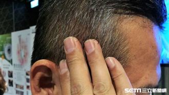 長白髮代表變老？研究：恐怕是身體在抗癌