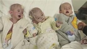 （圖／翻攝自微博）中國,貴州,無肛,三胞胎