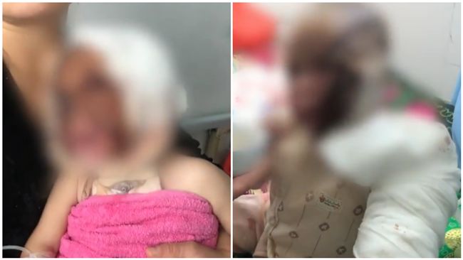 打翻滾燙水！雙胞胎全臉3度燒傷焦黑