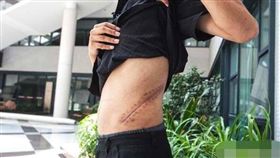 17歲少年賣腎買iPhone現況慘（圖／翻攝鳳凰網）