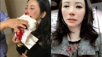 正妹遭健身男友毆打　鼻樑斷裂狂噴血