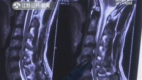 躺沙發上滑手機，陸男差點造成癱瘓。（圖／翻攝自《每日頭條》）