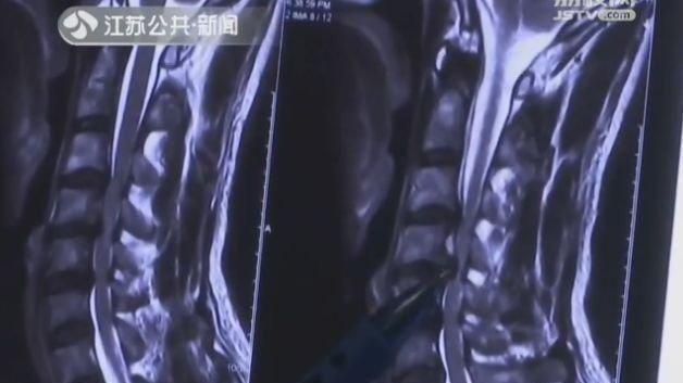 男天天黏沙發滑手機！脊椎薄成線險癱