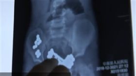 大陸,健身器材,鋼珠,吸鐵石,腸道沾黏(圖/翻攝自梨視頻)