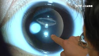 泡棉槍打中！少年水晶體破裂變白內障