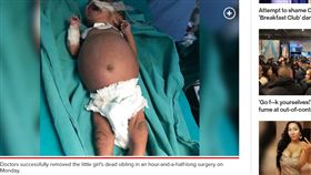 印度,胎兒,女嬰,胚胎,寄生胎
https://nypost.com/2019/01/03/girl-born-with-twin-inside-her-stomach-has-dead-sibling-removed/?utm_medium=SocialFlow&utm_source=NYPFacebook&sr_share=facebook&utm_campaign=SocialFlow