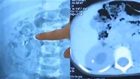 結石,買粉,捕鈣,超音波,女童,腎障,輸尿管,　圖／翻攝自微博