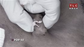 珊卓拉李,TLC,旅遊生活頻道,擠痘痘,腫塊,脂肪瘤,戰痘醫師
圖／TLC提供