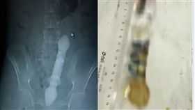 急診室,菊花,玻璃棒,肛門,卡住,大陸,浙江,玩具,手術,大喊　圖／翻攝自微博　
