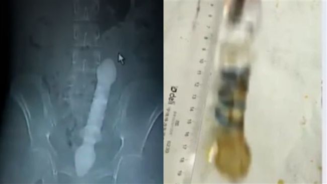 玻璃棒塞肛門卡住！男嚇壞：醫生救我