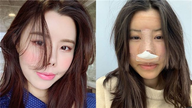傷照曝光！金老佛爺開刀拿鼻子崩潰了