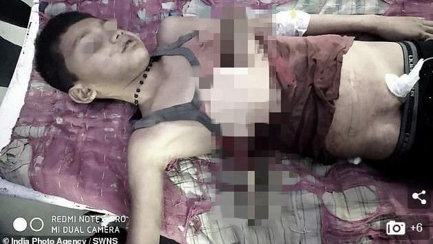 男童遭樹枝刺穿胸膛　忍痛先牽妹回家