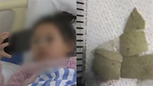 吃麵誤吞蛋殼！6歲女童咳血險喪命