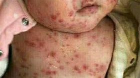 江蘇,過期疫苗,紅疹,嬰兒,幫忙（圖／翻攝自微博）