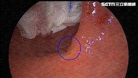 亞洲大學附屬醫院,大腸直腸外科,江驊哲,罹癌,壓力大,直腸癌