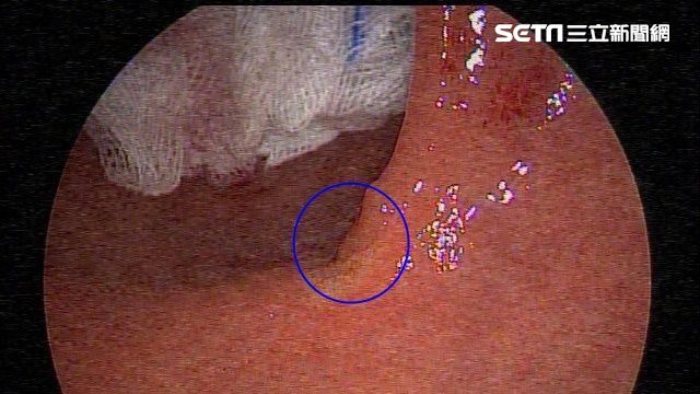 生活規律53歲教師　血便月餘竟罹癌