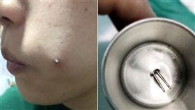 大陸,酒窩,鋼釘 圖／翻攝自楚天都市報