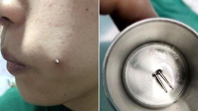 肖想有酒窩　妹子竟往臉上打鋼釘