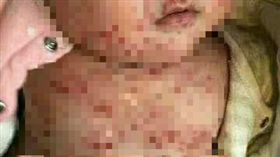 江蘇,過期疫苗,紅疹,嬰兒,幫忙（圖／翻攝自微博）