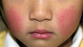 症狀類似感冒，臉頰會出現紅疹的「傳染性紅斑」，又稱為「蘋果病」，目前正在日本東京等地流行。孕婦感染後可能會對胎兒造成不良影響，各地方政府呼籲民眾多加留意。（圖／翻攝自@ fadeoutxkila2推特）