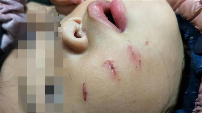 扯！2歲女童幼兒園遭咬傷　畫面曝光